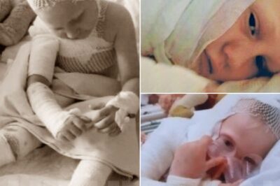 The scream still echoes in their hearts — a sound no parent should ever hear. It happened in seconds. Boiling oil spilled, and little Gabryś’s world turned into fire. By the time help arrived, nearly 40% of his tiny body was burned. For months, he lay wrapped in bandages, his body covered in wounds that refused to heal. Each dressing change was agony, each day a fight for life. His parents stayed beside him through every surgery, every tear. Even now, two years later, the battle isn’t over. Gabryś needs constant treatment — special creams, compression suits, and laser therapy to soften his scars and ease his pain. “If I could take his pain, I would,” his mother whispers. “He’s suffered enough. He just wants to live, to laugh again.” Read the rest of this brave little boy’s story in the comment below.👇